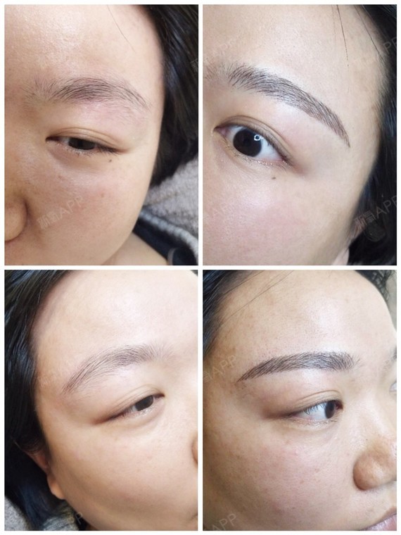 带着我妈妈来改眉毛,以前纹的老式眉毛都变成蓝色了,_圈子-新氧美容