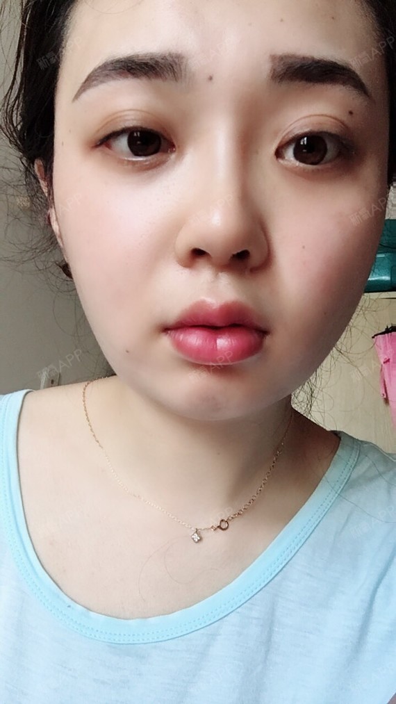 m唇手术