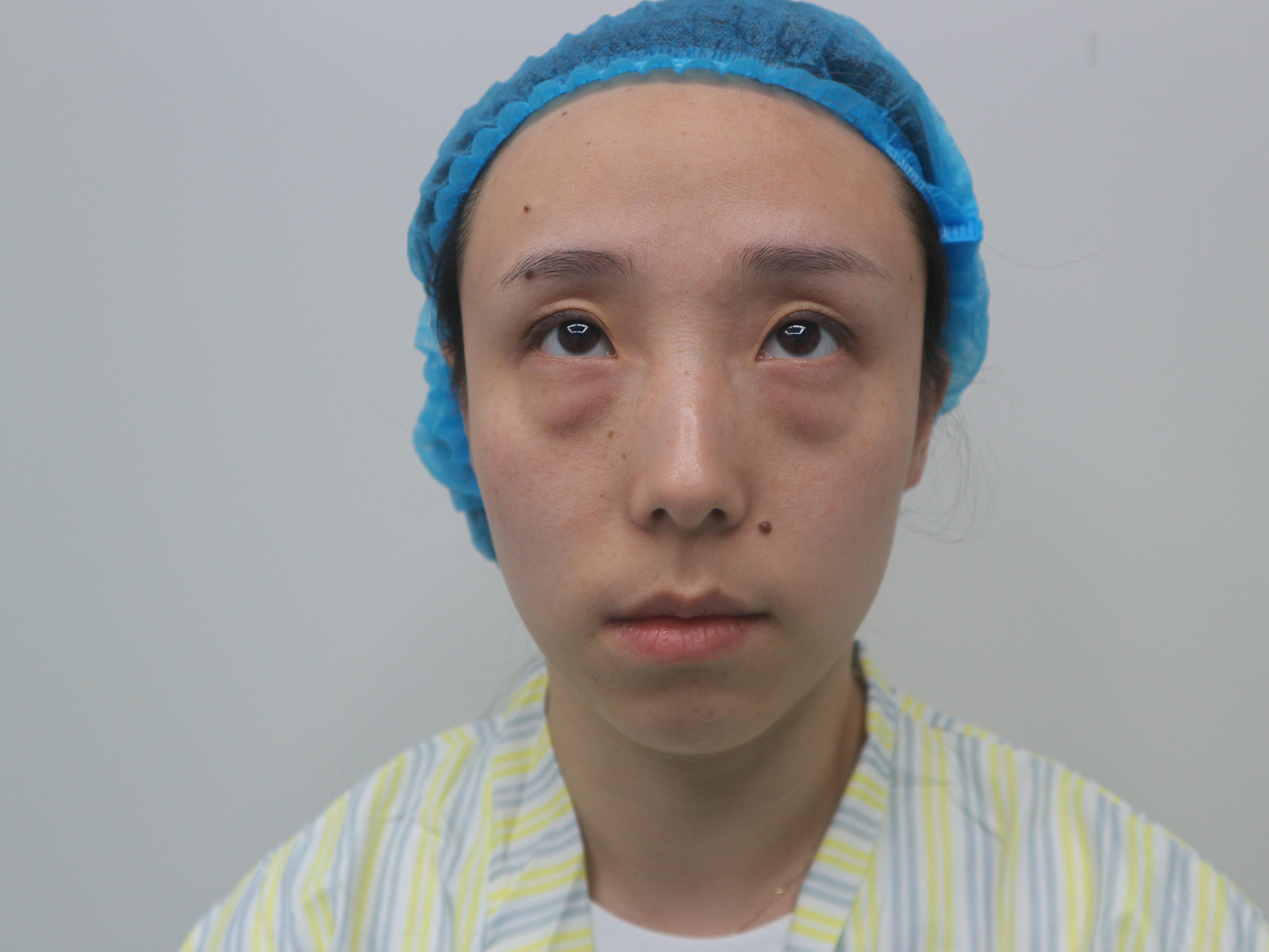 严重肿胀期眶隔脂肪释放第0天 · 第1篇日记