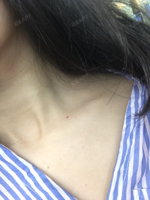 锁骨整形听过吗?30分钟就能get迷人锁骨窝