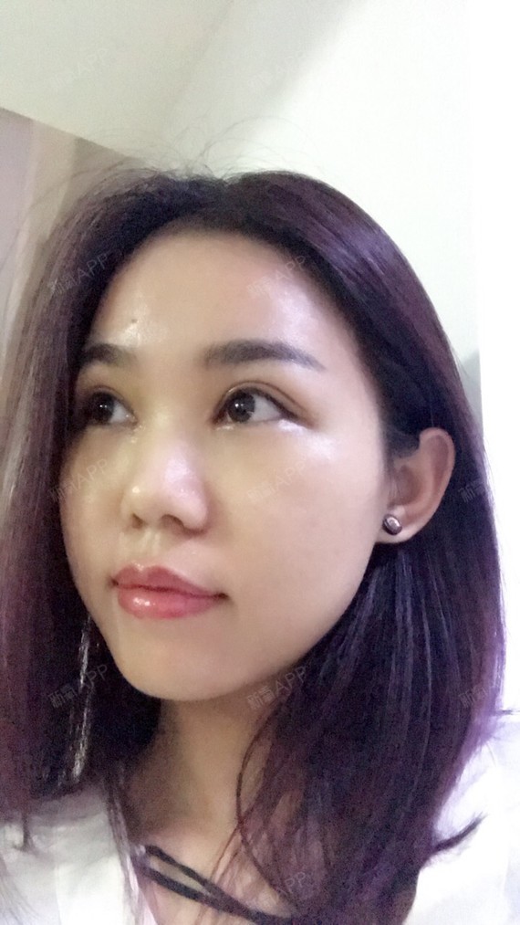 上眼睑去脂好不好_效果图_刘芸_上眼睑去脂术后第7天_新氧美容整形