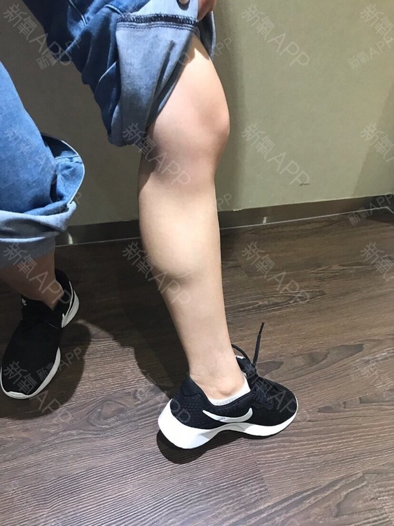 100单位有的地方不到1000,有的也就1000,当然,肉毒素针对的是肌肉腿