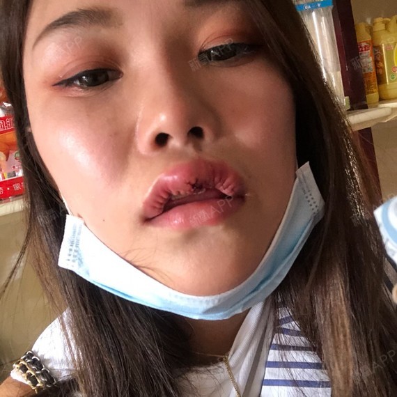 m唇手术