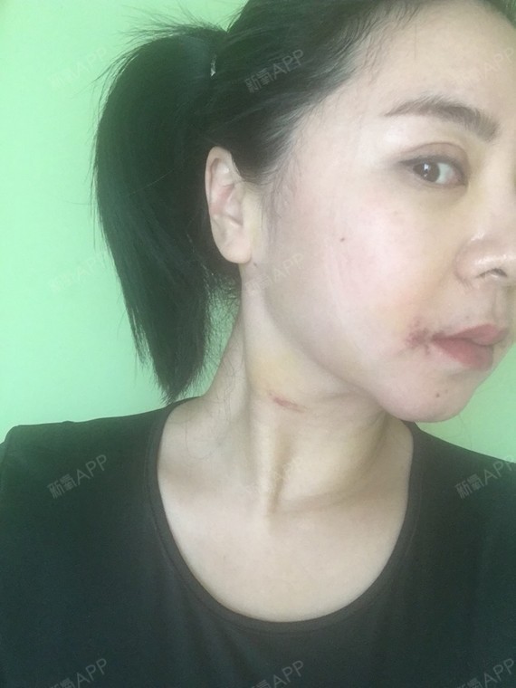 以前右脸无论什么姿势都看不到下颚角,现在这个姿势能看到了!开心