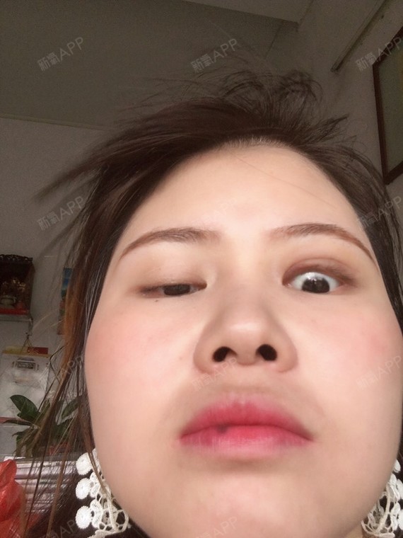 上睑提肌