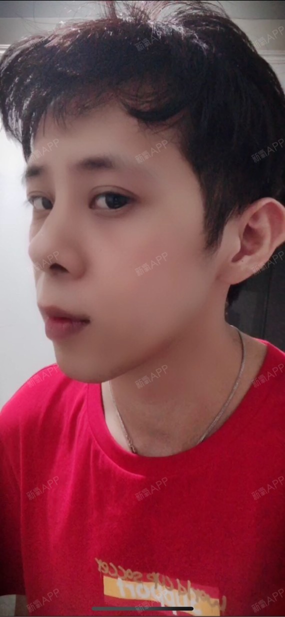 正面和侧面看整张脸凹凸不平的,脸很长,嘴巴特别突出,牙齿咬合正常