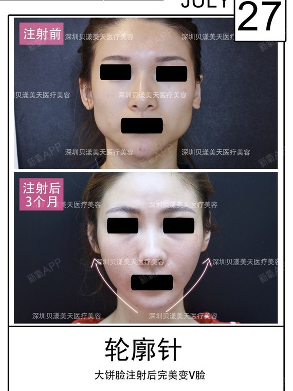 轮廓针|尖货!瘦脸针再次更新,塑造精致v脸轮廓,明