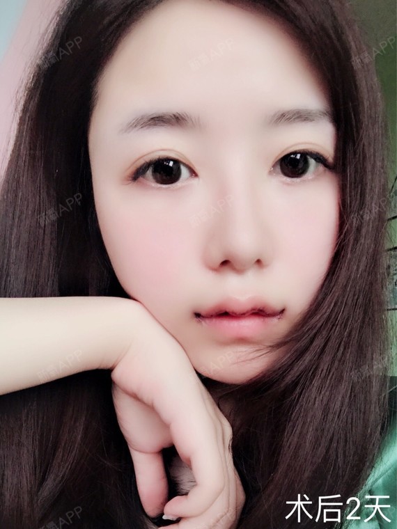 做m唇微笑唇综合要恢复多久?