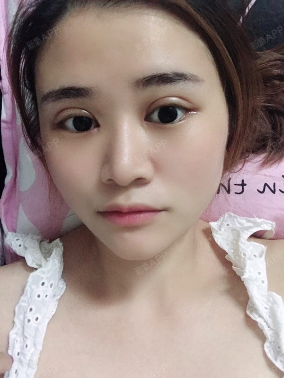 开内眼角