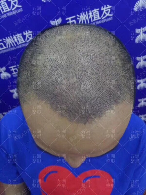 武汉五洲莱美整形美容医院头顶加密种植第0天