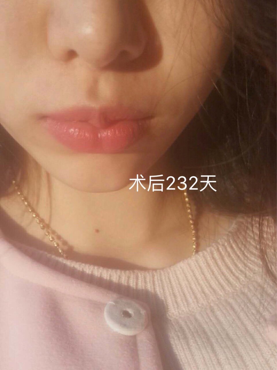薄m唇微笑唇花瓣唇综合术后一年反馈02一直觉得_圈子-新氧美容整形