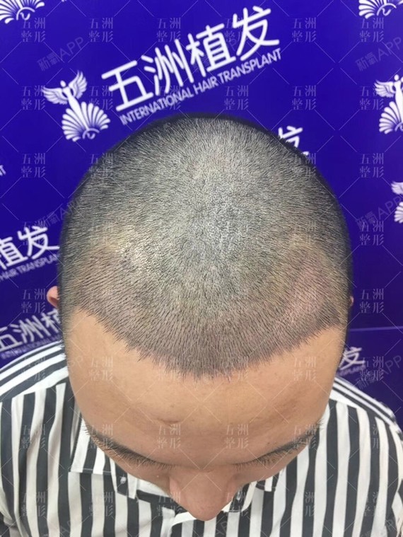 武汉五洲莱美整形美容医院种植发际线第2天美
