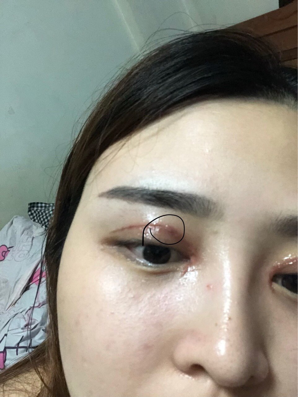 做完双眼皮后上面有颗小黑点是什么啊,像这_圈子-新氧