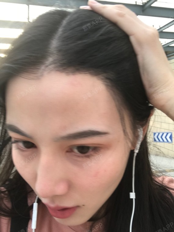 脖子了,前面种植区的头发已经长到鼻子了,我发现种植的发际线跟天生的