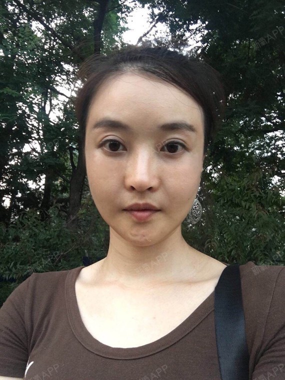 术后7个月的鼻子,假体太假 ,鼻头下垂,鼻孔一高一低