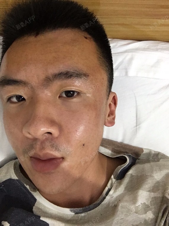 术前额头太阳穴凹陷,主要是大小脸.下午去做的填充