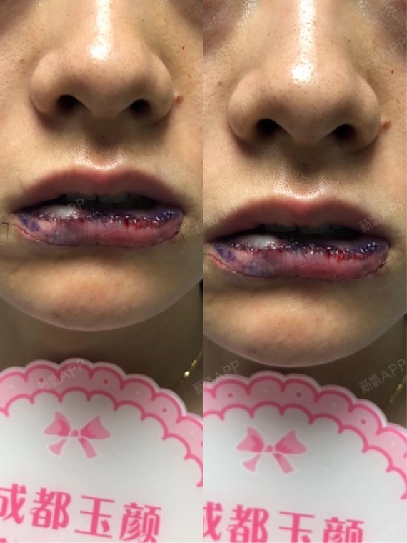 我本身是有着先天性嘴巴血管瘤,在别的医院做了手术后,不但没解决到