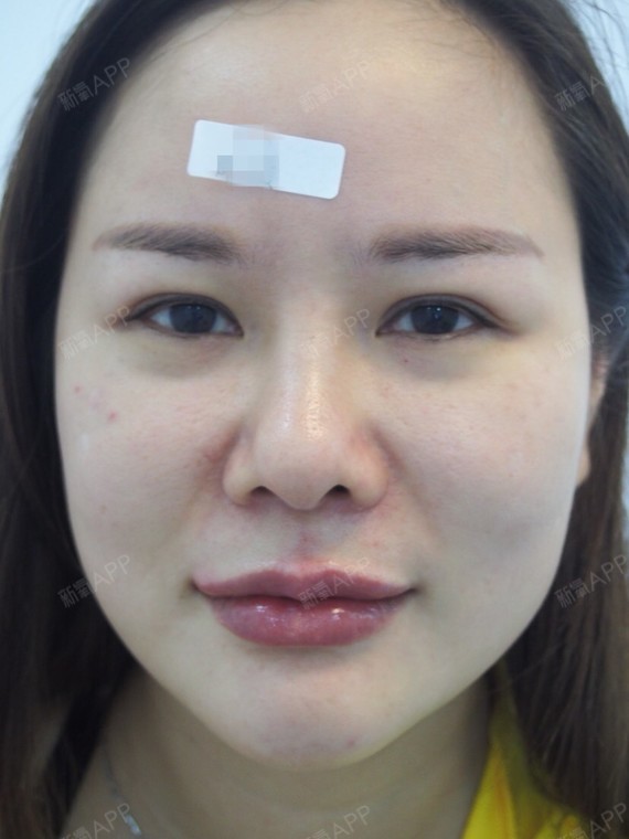 满头杨花共白首df自体脂肪全脸填充第30天美丽