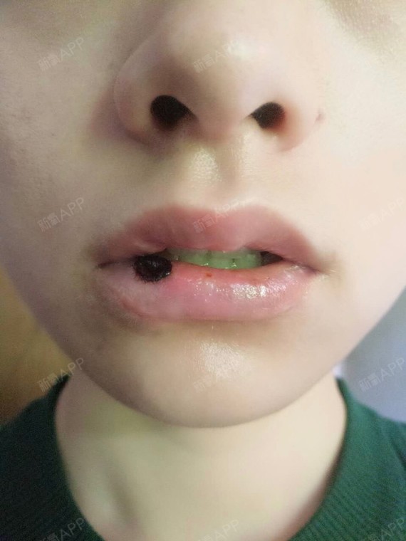 说一说唇部缺陷唇部修复手术