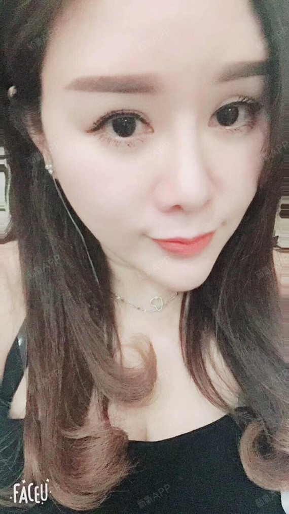 满头杨花共白首df自体脂肪全脸填充第45天美丽