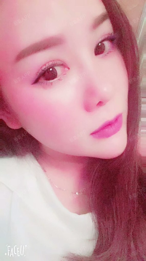 满头杨花共白首df自体脂肪全脸填充第45天美丽