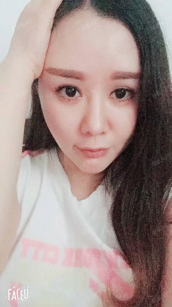 满头杨花共白首df自体脂肪全脸填充第45天美丽