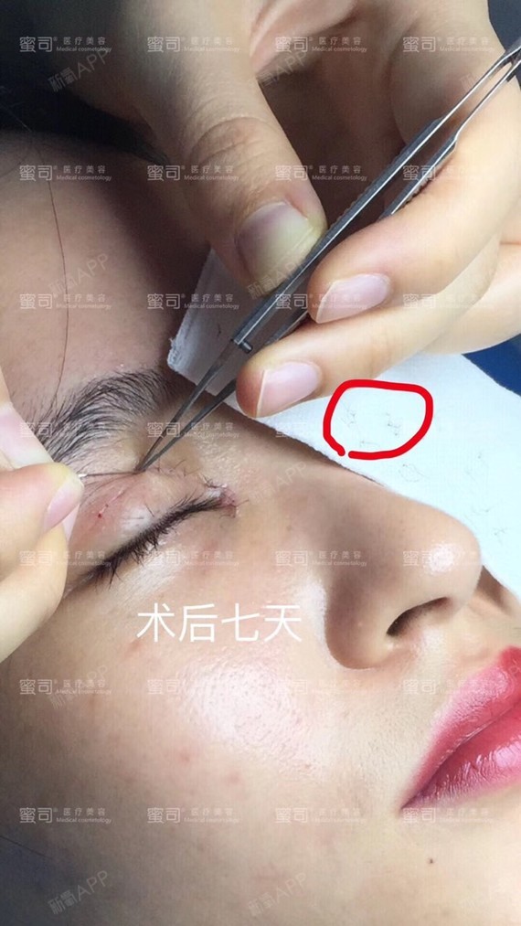 【武汉蜜司医疗美容,双眼皮拆线疼吗?