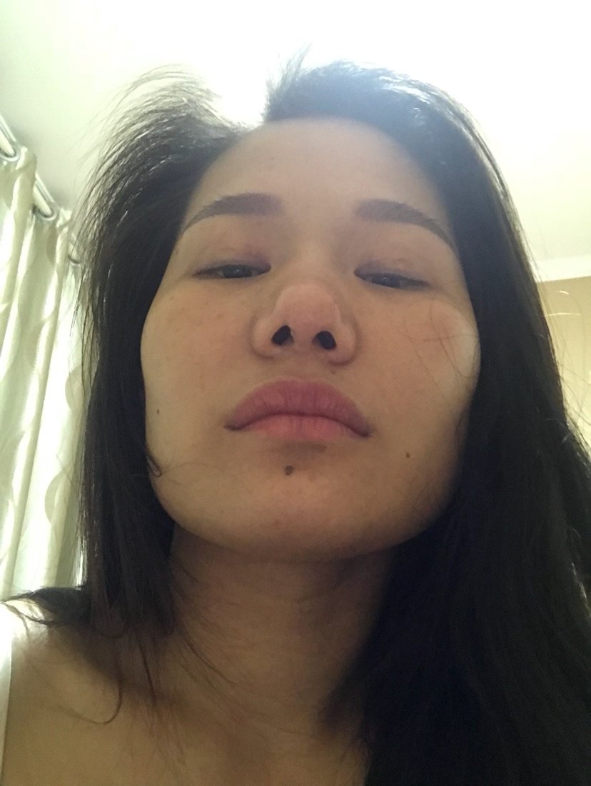 鼻头增生萎缩了,对假体有排异,这种好修复不