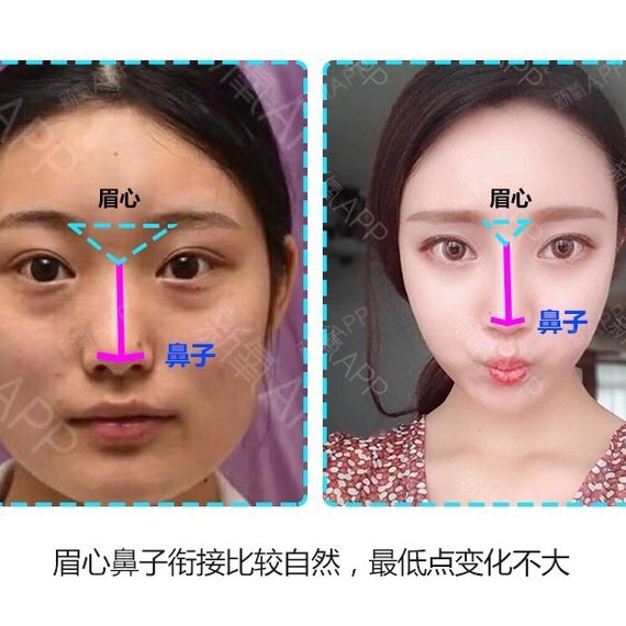 眉心,鼻子关系不对,鼻子再高也白费