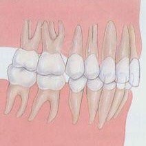 地包天(图3)体现为下排牙齿在上排牙齿的外面