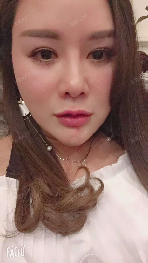 满头杨花共白首df自体脂肪全脸填充第90天美丽