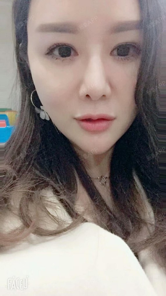 满头杨花共白首df自体脂肪全脸填充第90天美丽