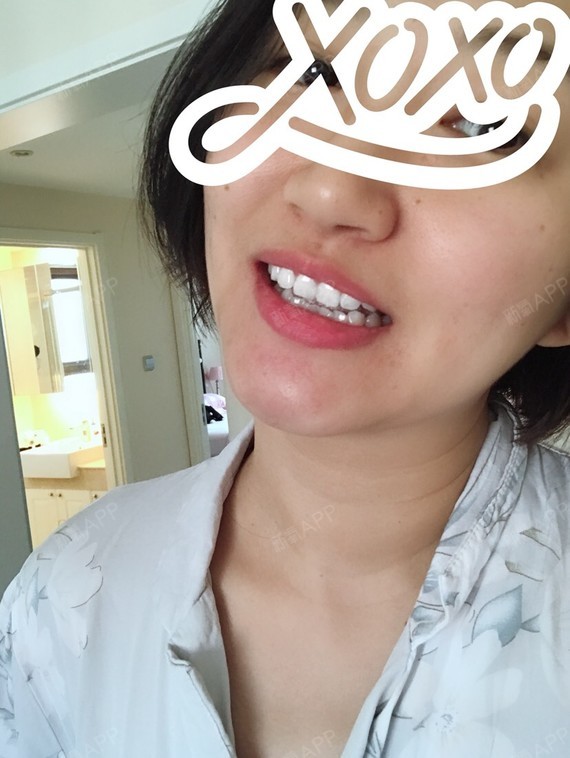 新氧- 妮妮妮妮啦 | 牙齿 | 冷光美白 | 术后当自强 | 北京同城