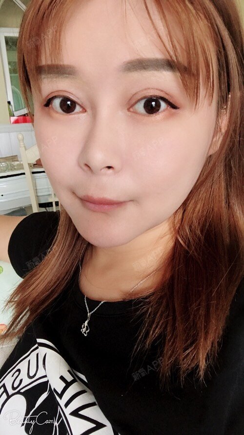内切去眼袋 | 切开双眼皮 | 术后当自强 | 上眼睑 | 上眼睑去脂