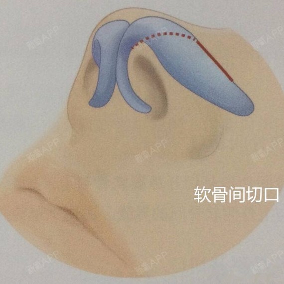 关于鼻部整形手术切口的讨论鼻部整形手术切口