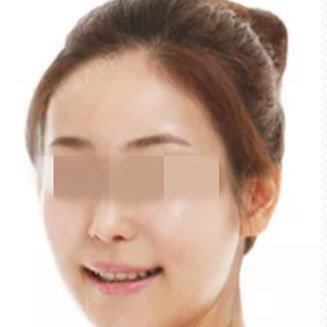 氧气xr9uw玻尿酸全脸填充第28天美丽日记-新氧