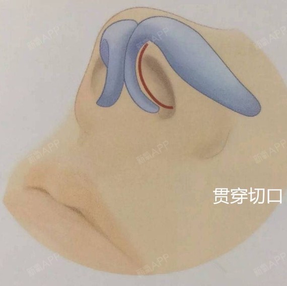 关于鼻部整形手术切口的讨论鼻部整形手术切口
