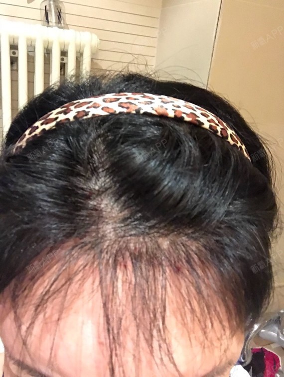 林妮姐姐种植发际线第214天美丽日记-新氧美容