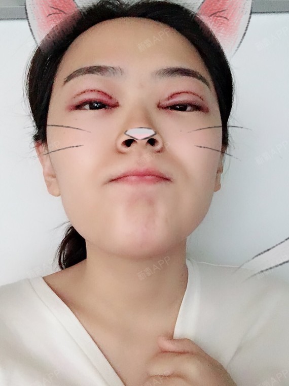 【开内眼角失败能修复吗?会回缩/增生吗】98开内就