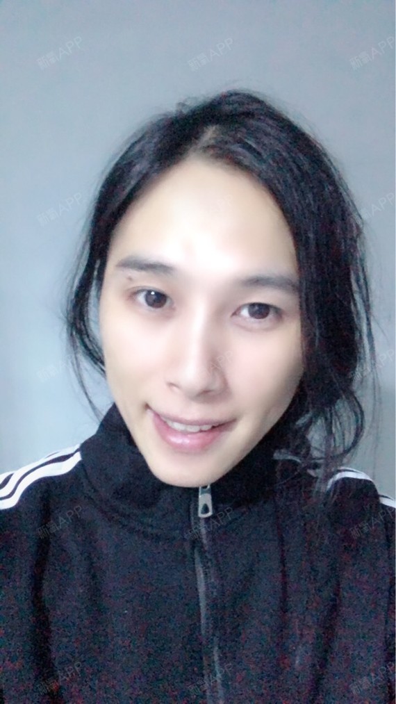 嘟嘟哥上下颚手术/突嘴矫正第49天美丽日记