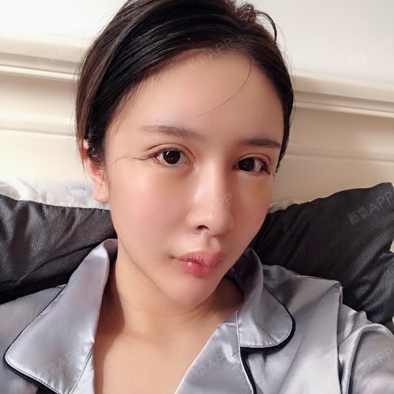 m唇手术