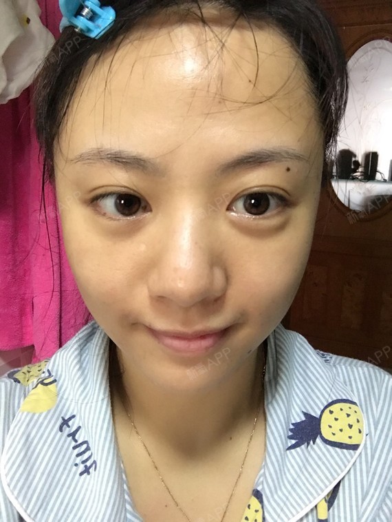 其他 | 联合治疗 | 眼部抗衰 | 熊猫针去黑眼圈 | 眶隔脂肪释放