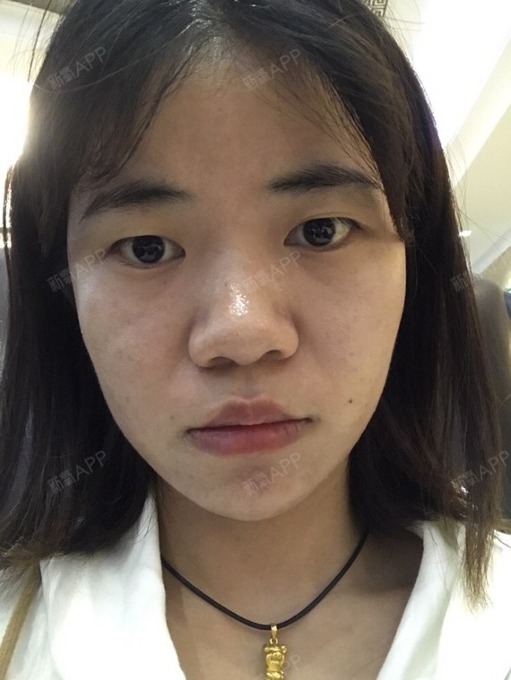 名字太长了超微小气泡第1天美丽日记-新氧美容