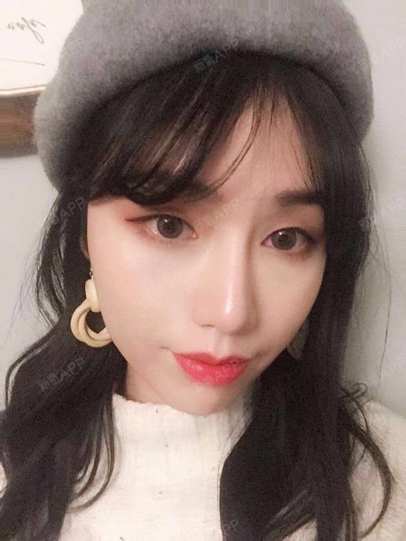 积极笠我手术缩鼻头第379天美丽日记-新氧美容