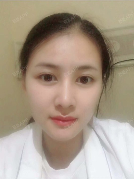 氧气xu1vw鼻综合第7天美丽日记-新氧美容整形