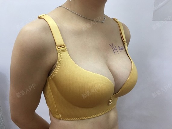 新氧- 江南女人 | 鼻部 | 胸部 | 美体塑形 | 隆胸 | 大腿吸脂 | 假体
