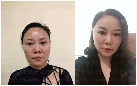 强生鱼骨线 线雕案例
