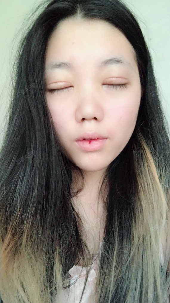 埋线双眼皮 | 切开双眼皮 | 术后当自强 | 上眼睑 | 上眼睑去脂