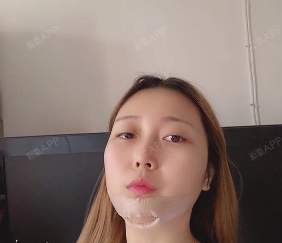 长沙取颊脂垫瘦脸好不好_效果图_姐是数学学霸取颊脂3