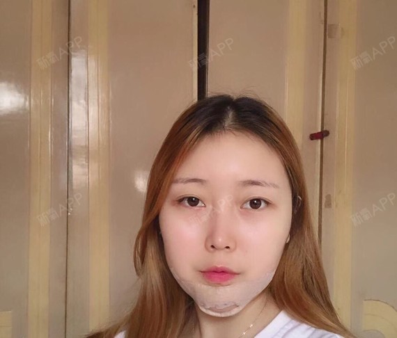 长沙取颊脂垫瘦脸好不好_效果图_姐是数学学霸取颊脂3